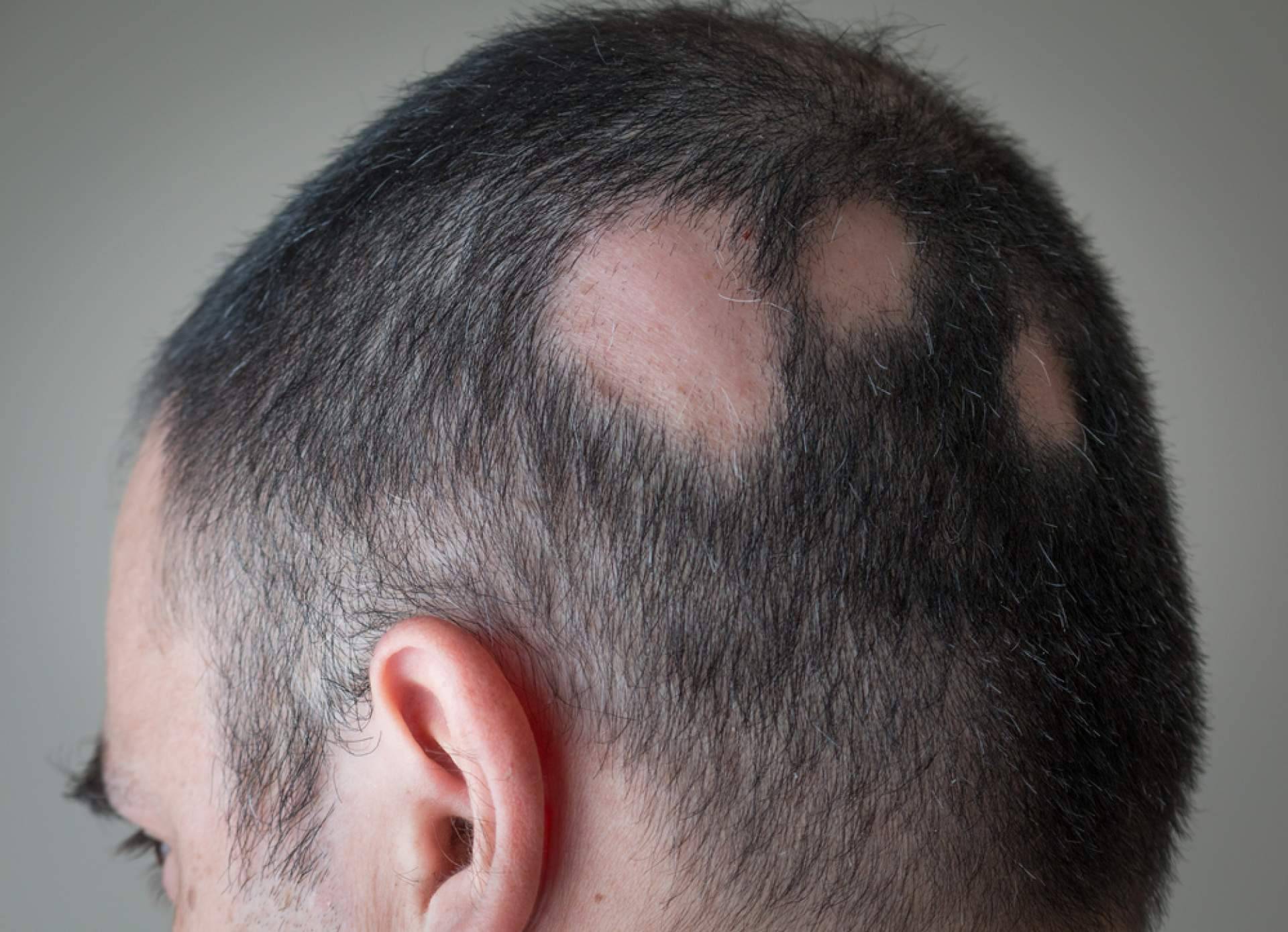Alopecia Areata, ¿qué es y cómo disimularla?