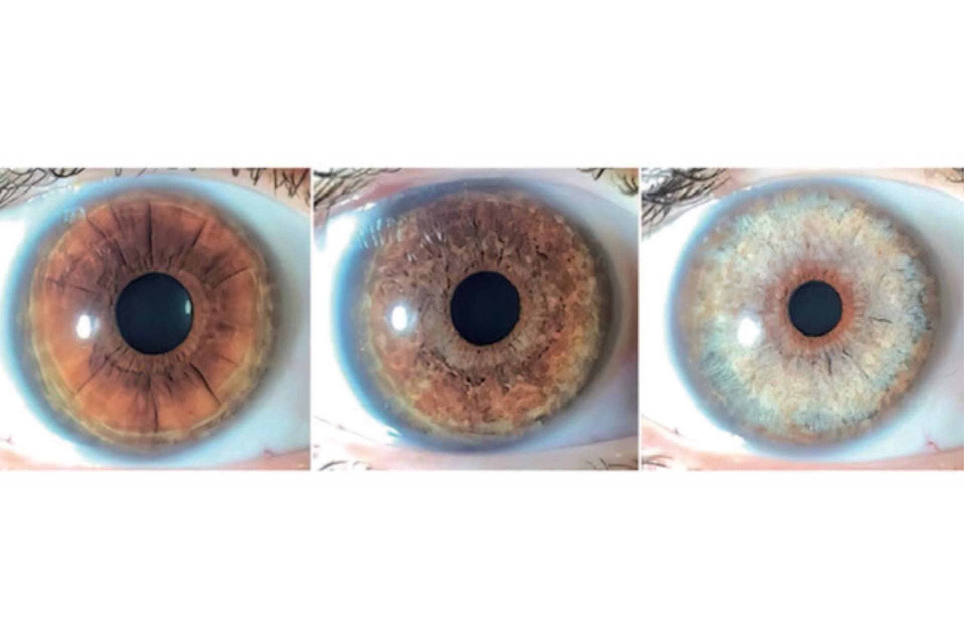 Clínica Eyecos informa de que los productos crece pestañas pueden oscurecer los ojos
